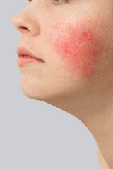 Rosacea